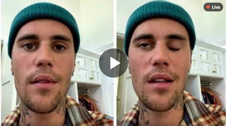 Justine Bieber Bells Palsey